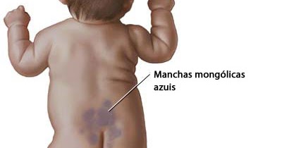 mancha mongol 0a8370_c3af2d2347a14dc5901c6df8d1f8050a-mv2